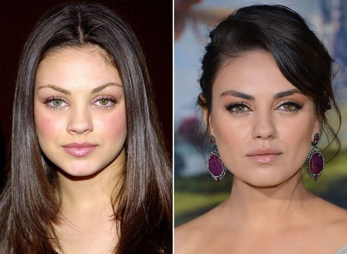 Antes e depois da bichectomia da atriz Mila Kunis