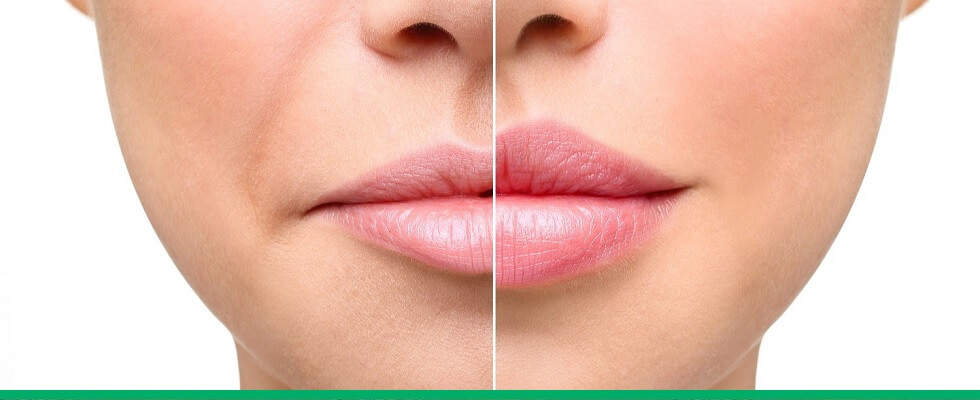Preenchimento labial: antes e depois